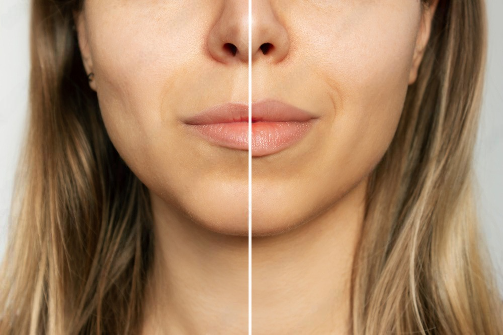 Before and after comparison of lip fillers showing enhanced lip volume and definition for a fuller, natural look.