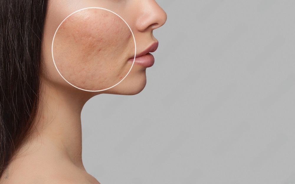 Acne scars on face reduced via microneedling