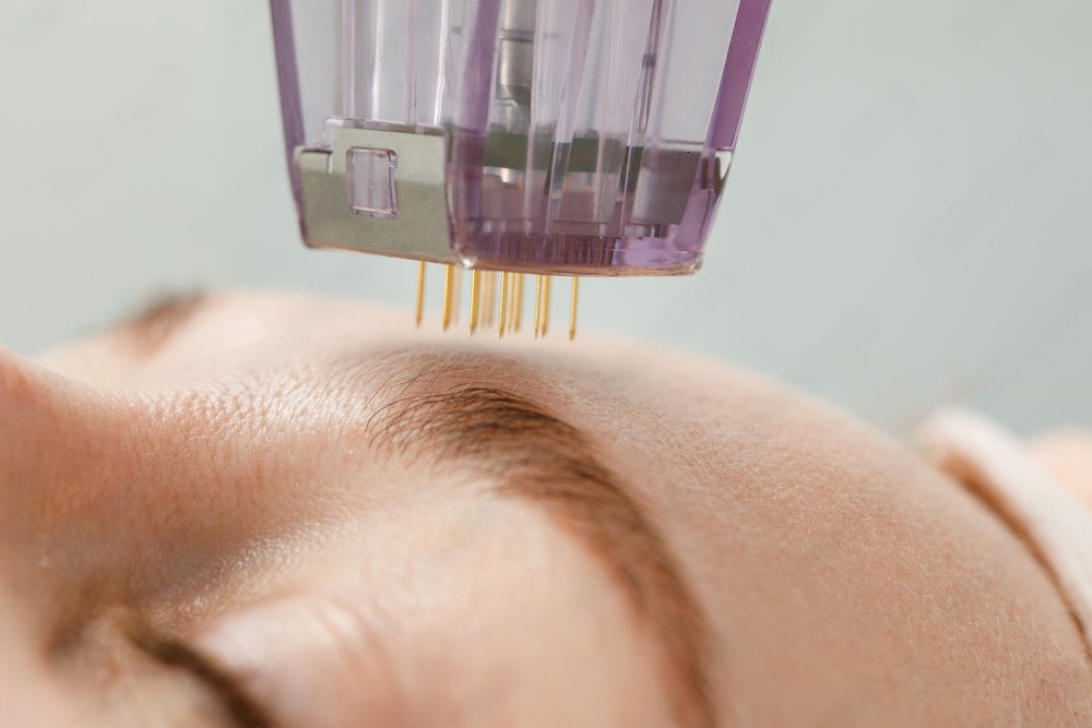 microneedling process